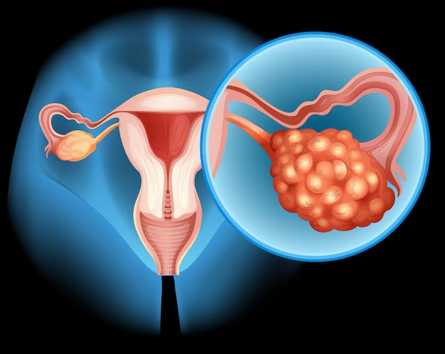 Pcos and female reproductive endocrinological management