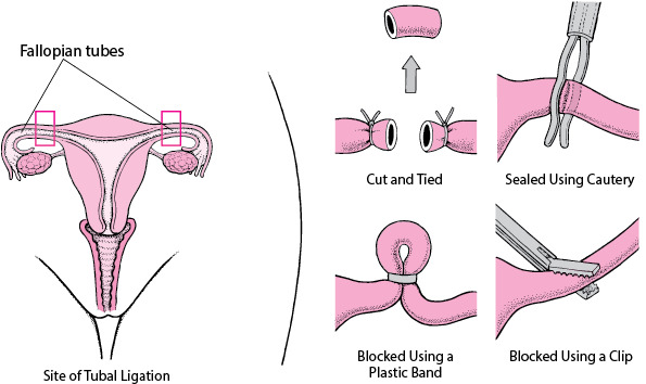 contraception and Sterilization